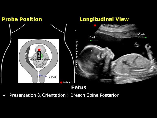 Obstetric Ultrasound Probe Positioning | Pregnant Uterus & Fetus Transducer Placement USG Scan