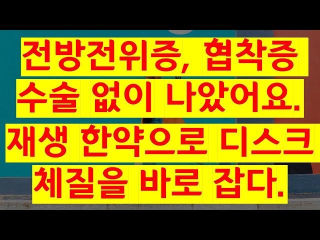 전방전위증, 협착증 수술 없이 나았어요.