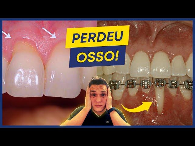 PERDA ÓSSEA AO REDOR DOS DENTES: O QUE CAUSA E COMO EVITAR?