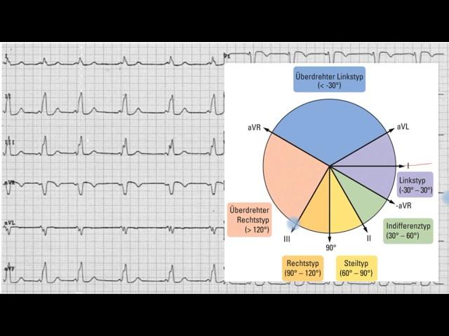 Ekg Basics Vlog 4, Lagetypbestimmung Part 2 (deutsch)