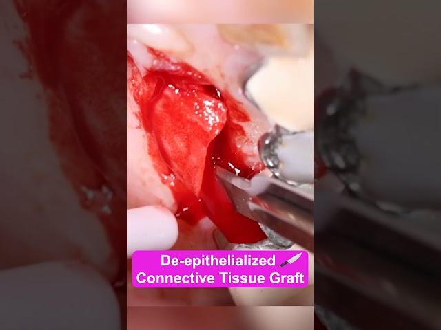 De-epithelialized Connective Tissue Graft #dentalimplants #implantdentist #connectivetissue