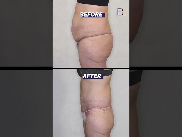 Belt Lipectomy Before and After (Patient 2020-1024) #shorts