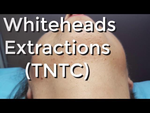 Whiteheads Extraction (TNTC) - Session I - Part 1