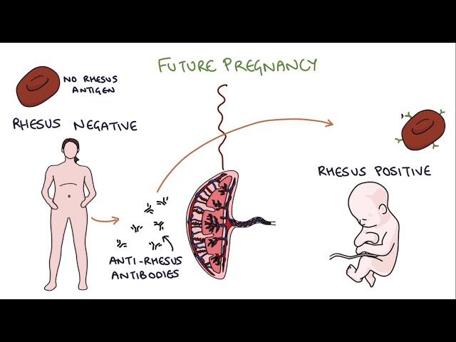 Understanding Rhesus Status and Anti-D in Pregnancy