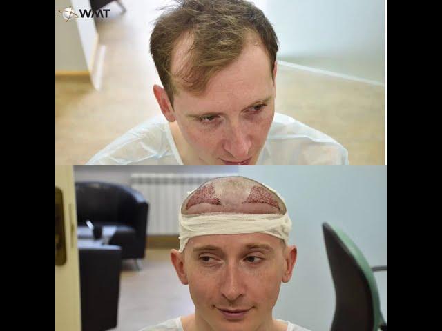 Пересадка волос в клинике WMT