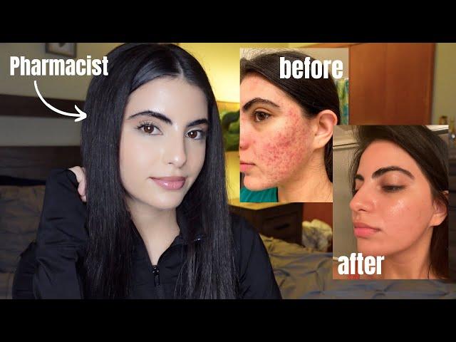 How I Cleared My Severe Cystic Acne: Simple Skincare Routine & The BEST Advice | *No Accutane*