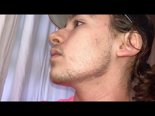 Timelapse of 4 Months of Minoxidil and Derma roller Beard Growth