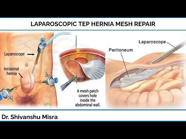 LAPAROSCOPIC TEP HERNIA MESH REPAIR | DR SHIVANSHU MISRA