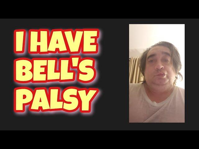 I HAVE BELL'S PALSY | PARALYSIS TO ONE SIDE OF MY FACE | MUST WATCH