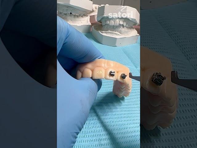 Фиксация брекетов #braces #брекеты #стоматология