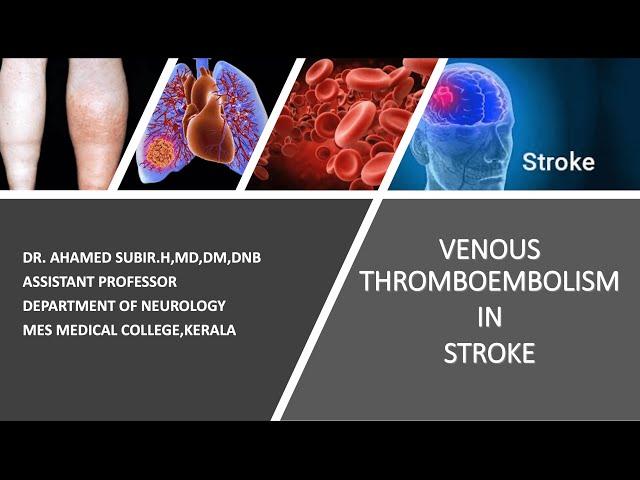 STROKE ESSENTIALS#VENOUS THROMBOEMBOLISM IN STROKE SIMPLIFIED#MUST KNOW IN STROKE