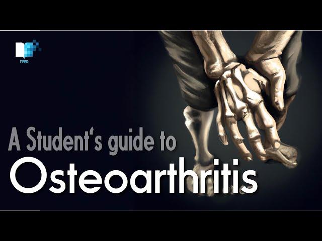 What is Osteoarthritis? An overview of its epidemiology, pathophysiology, diagnosis and treatment.