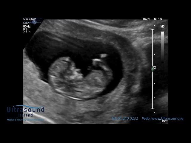 Scan of the Week: 12 Week Advanced Early Scan