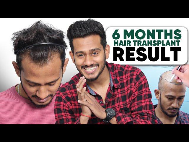 Hair Transplant in India | Best Results & Cost of Hair Transplant in India