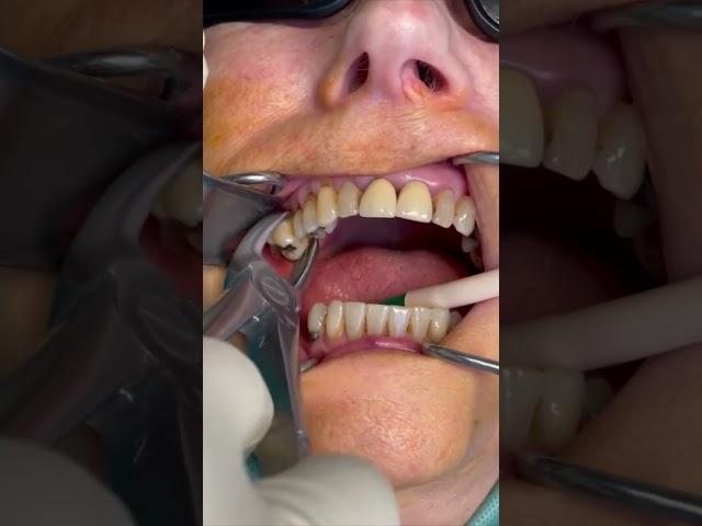 Beautiful tooth extraction | painless dentistry #shorts #health #beauty