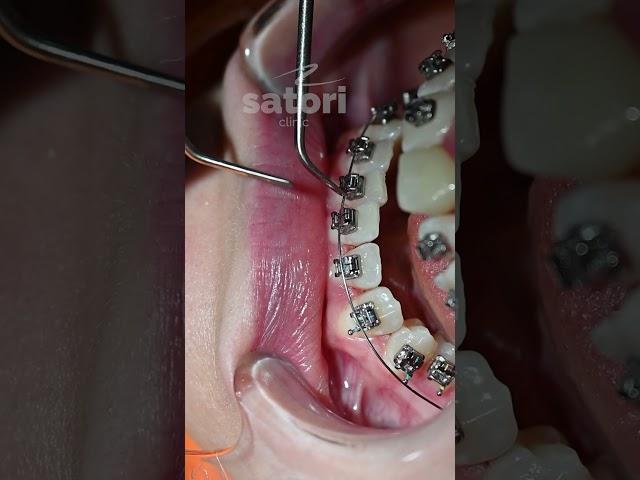 Брекеты самолигирующие InOvation  #брекеты
