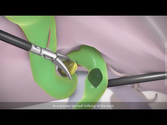 Laparoscopic Common Bile Duct Exploration | TVASurg