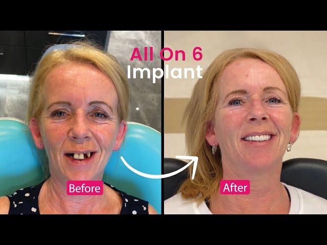 Angela's incredible transformation with all-on-6 implants at Elite Dental Clinic in Kuşadası!