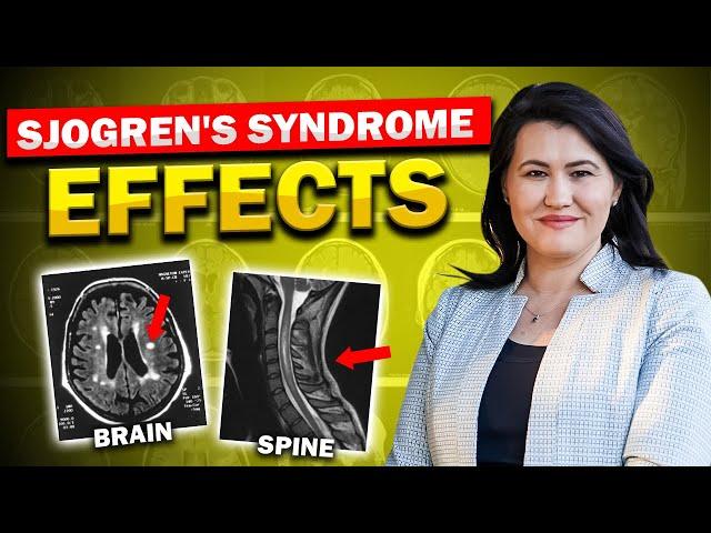 Sjogren's Syndrome Affects the Brain and Spine