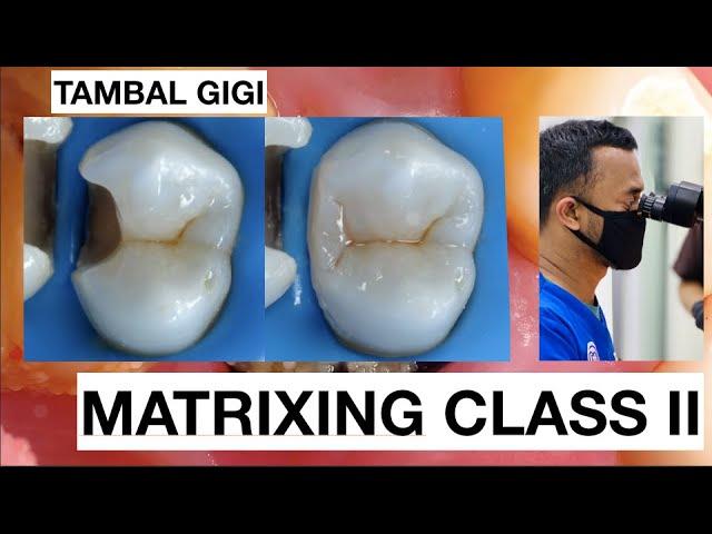 Step by Step Matrixing Class II Premolar | General Dentist Griya RR