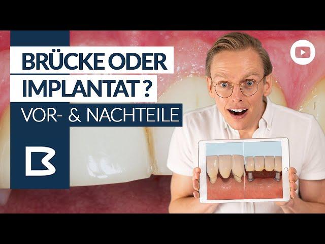 ZAHNBRÜCKE oder IMPLANTAT: Vor- & Nachteile; 3D Animation!