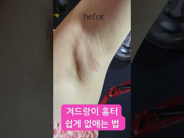겨드랑이 흉터 타투로 쉽게 지우자 #흉터#흉터제거#흉터타투#기미#기미제거#기미타투#튼살#튼살제거#튼살타투#다크서클#다크서클제거#피부관리#다크서클타투#대구타투#대구#지워지는타투