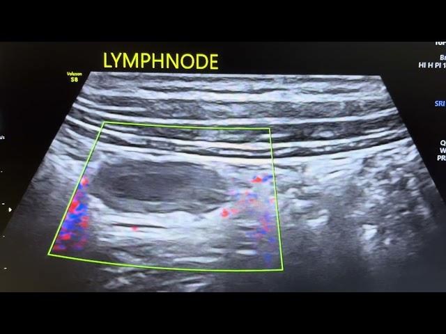 Lymphnode with internal necrotic changes.