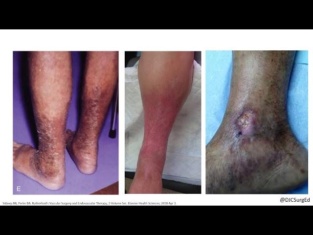 Venous Disease