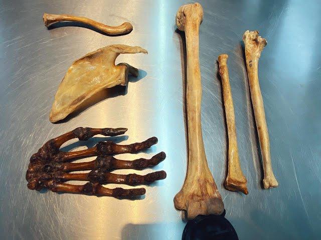 Esqueleto Apendicular - membros superiores (nomenclaturaras e acidentes ósseos)