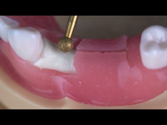 How to Start a Dental Implant Preparation - Implant Club