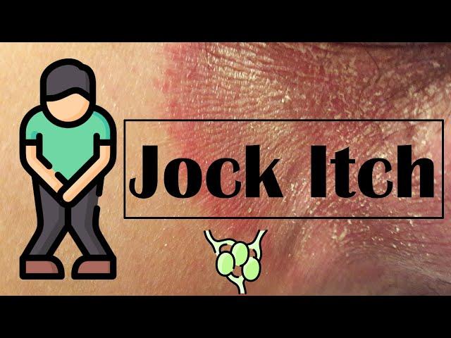 Tenia Cruris Infection (Jock Itch) - Causes, Risk Factors, Signs & Symptoms, Treatment