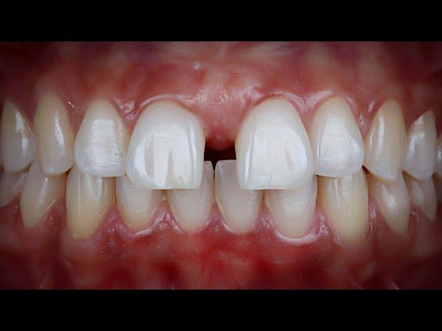 Niềng răng Invisalign trường hợp răng thưa | invisalign fix spacing teeth