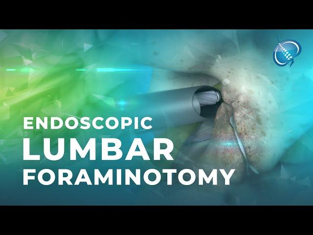 What is Endoscopic Lumbar Foraminotomy?