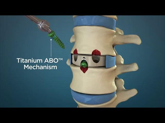 Centinel Spine: STALIF MIDLINE An Introduction