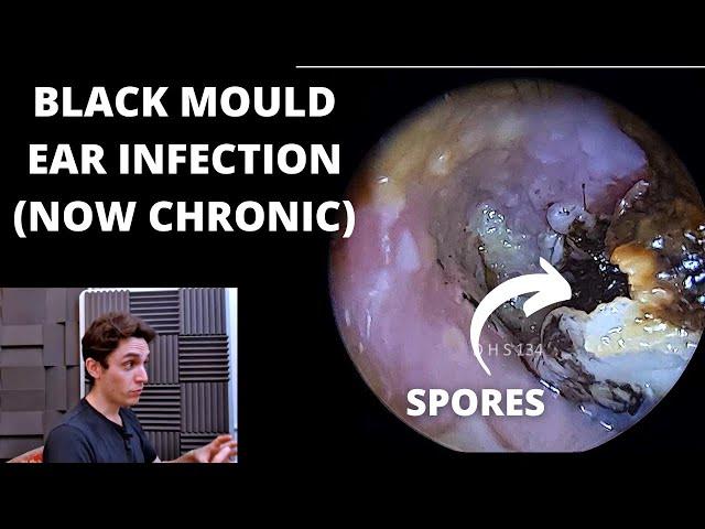 Black Mould Infection Is Now Chronic (Otomycosis)