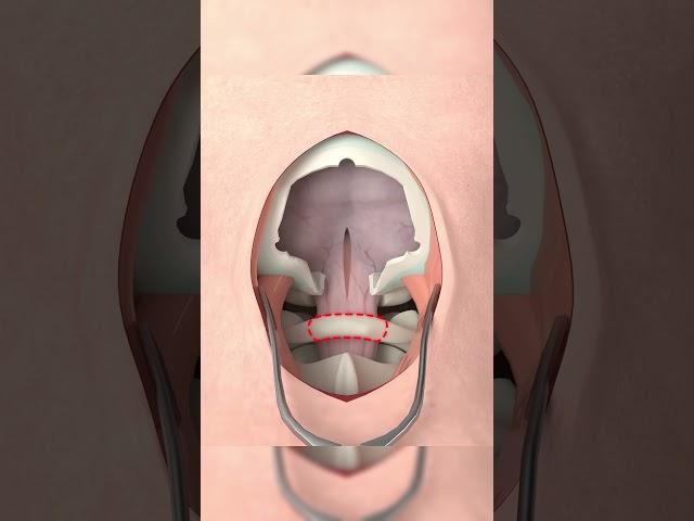 Craniotomia #medico #neurocirurgia #shorts