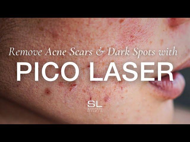 Pico Laser: The Solution for Acne Scars, Dark Spots & Enlarged Pores