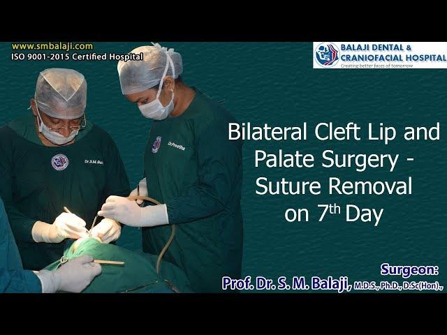 Bilateral Cleft Lip and Palate Surgery suture removal  on 7th day