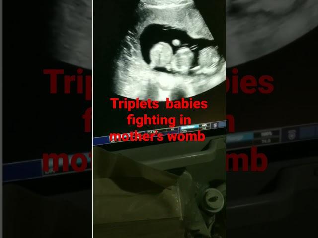 triplet pregnancy