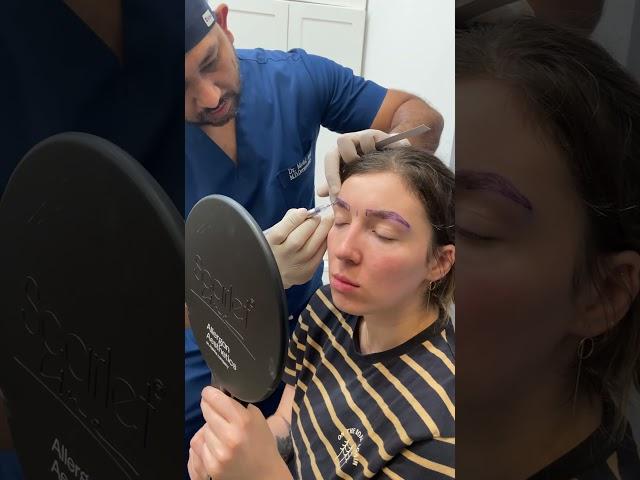 Eyebrow Transplant as Good as Shinobi Lineage | Cara Clinic