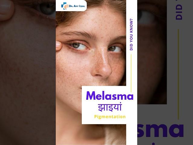 Melasma treatment @Designerdoctor #melasmatreatment #melasma #skin #dermatology