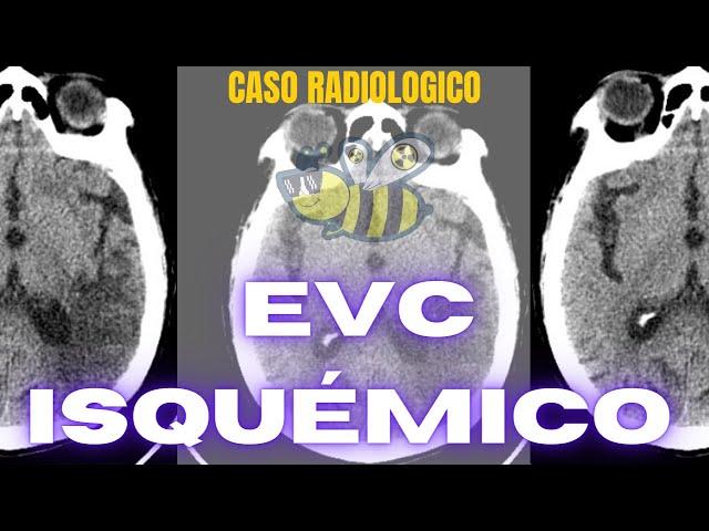 ▶️️ EVC ISQUEMICO  (accidente cerebrovascular, derrame cerebral, ictus, infarto cerebral)