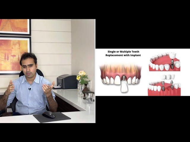 Option For Permanent Teeth Replacement | Expert Talk | In Gujarati Language with English Subtitle