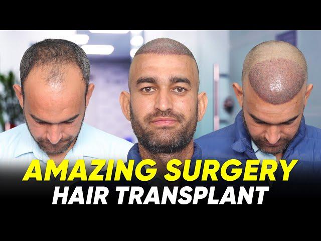 Hair Transplant in Kota | Best Results & Cost of Hair Transplant in Kota