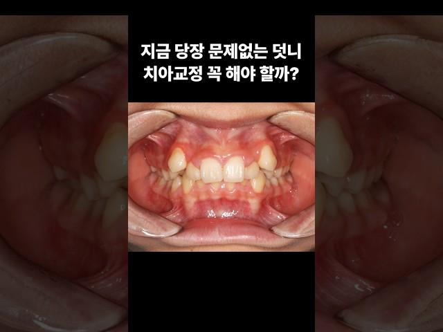 심한 덧니 치아교정을 해야 하는 이유! #덧니교정 #인비절라인 #치아교정치과