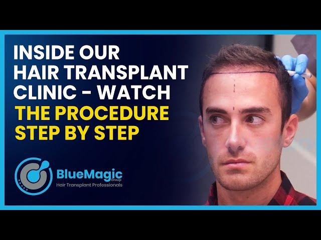 From A to Z: Inside Our Hair Transplant Clinic - Watch the Procedure Step by Step