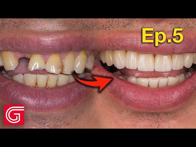 Delivering ZIRCONIA Crowns with Missing Tooth on #7 | Ep5