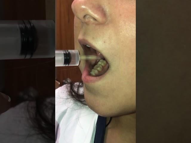 Irrigation of Wisdom Tooth Sockets