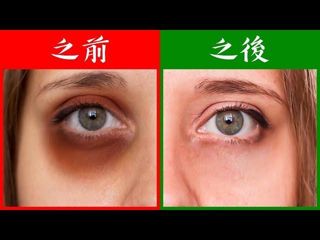 (眼睛11) 黑眼圈的原因, 外用和內服, 自然療法,柏格醫生 Dr Berg