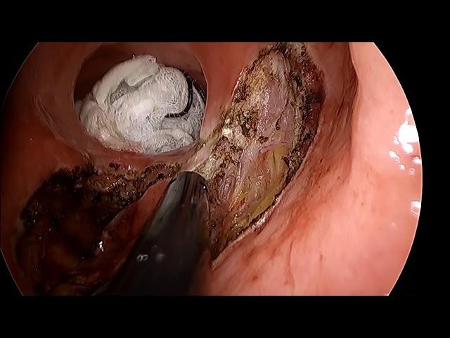 Transanal Minimally Invasive Approach for the Resection of Retrorectal Tumour